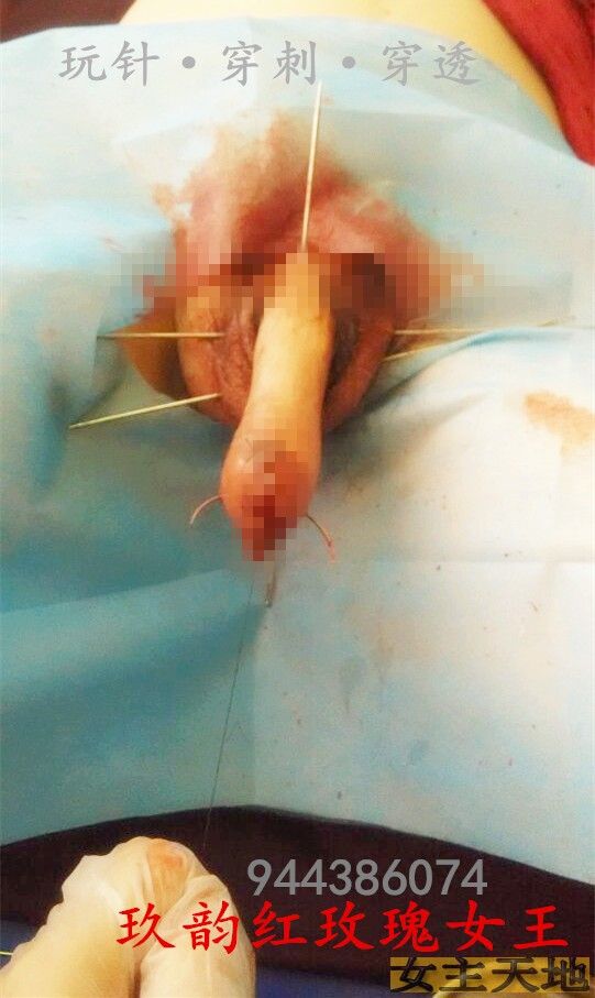 青岛玖韵红玫瑰---最早期重度虐阳针刺钉子放血没有shi频