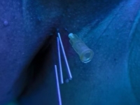 穿刺，注水，隆胸