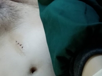 胭脂虎女医，往期模拟剖腹产手术案例。