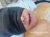 体位被固定“手术床上”，手术床是电动的，