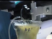 膀胱灌注生理盐水，再返回尿袋。医疗供体，没有尿尿的...